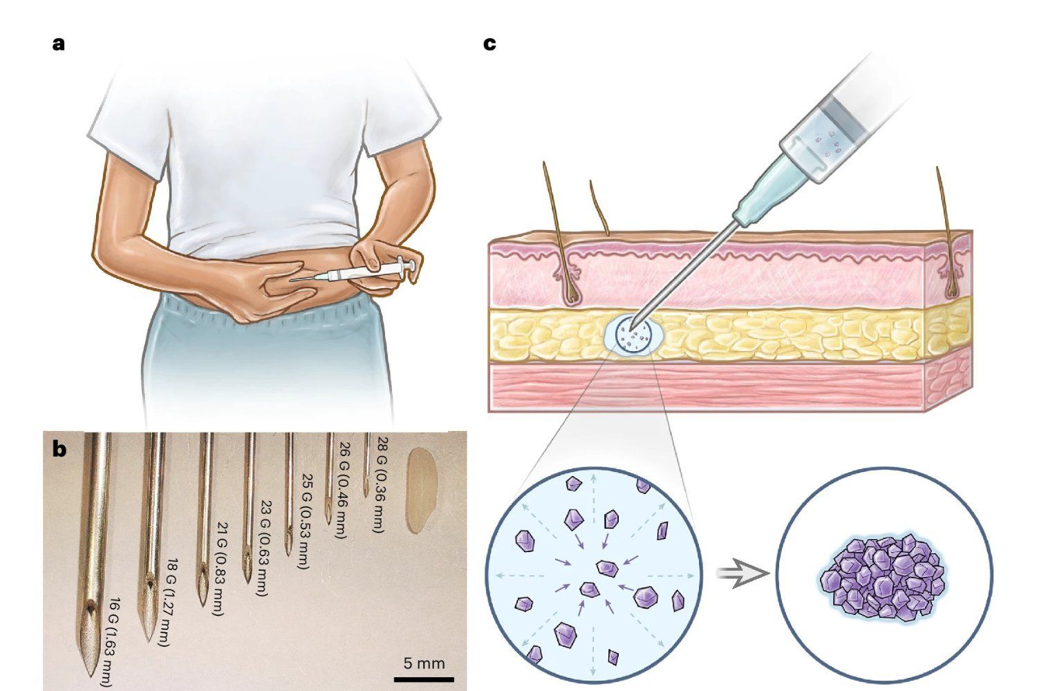 Implante Anticonceptivo